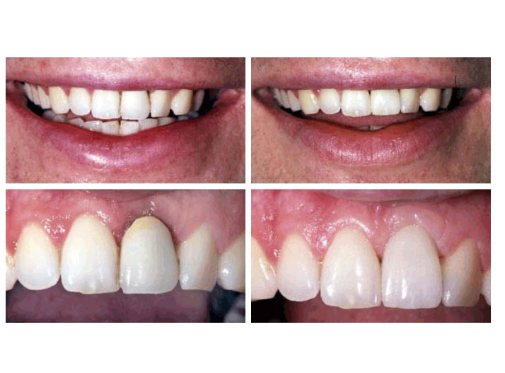 Ceramic Dental Crown